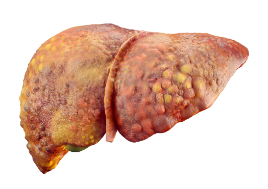 Fatty Liver Disease